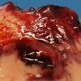 Ruptured WIlms tumor