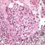 Cutaneous leishmaniasis