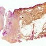 Cutaneous fistula complicating a chronic osteomyelitis