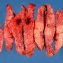 Placental infarction and thrombosis