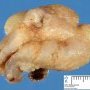 Nasal inflammatory pseudopolyp