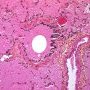 Adult alveolar proteinosis