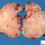 Salivary gland anlage tumor