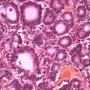 Pancreatic acinar cell carcinoma