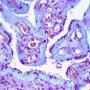 Placental mucolipidosis