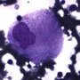 Gaucher cell in bone marrow cytology