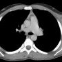 Axilary synovial sarcoma