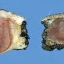 Lobular capillary hemangioma