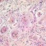 Cholestatis
