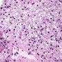 Lipofuscin in portal macrophages