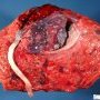 Placenta percreta and circumvallata (with marginal insertion)