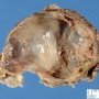 Abdominal cystic lymphangioma