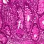 Rupture of a colonic crypt in colonic mucosal inflammation