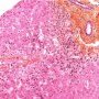Autoimmune hepatitis