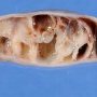 Ovarian cystic juvenile granulosa tumor