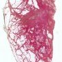 Fibrous hamartoma of infancy