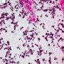 Embryonal botryoid rhabdomyosarcoma of the rhinopharynx