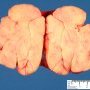 Mesenteric lipoma