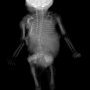 D12-L2 ertebral anomalies