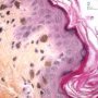 Griscelli syndrome - Skin