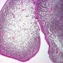 Embryonal botryoid rhabdomyosarcoma of the rhinopharynx