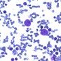 Parvovirus B19 cytopathogenic effect in bone marrow