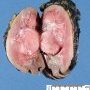 Wilms tumor with hilar extension