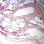 Pleuropulmonary blastoma type 1