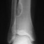 Metaphyseal fibrous defect