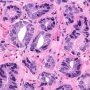 Gleason Pattern 3 (WebPathology)