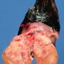 Testicular embryonal carcinoma