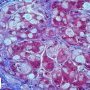 Glycogen storage disease type IV.