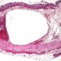 Colonic pneumatosis in cystic fibrosis
