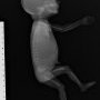 Humeral meromelia (fetus, 21 weeks)