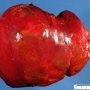 Hepatic ischemia in a liver allograft