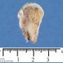 Osteochondroma