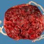 Triple pregnancy placenta