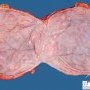 Ovarian serous cystadenoma