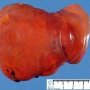 Hepatic ischemia in a systemic sepsis