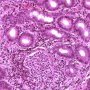 Gastric acute glandulitis and glandular abcess