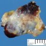 Glomangioma