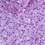Lipofuscin in portal macrophages