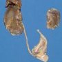 Uniateral renal agenesis in a malformative syndrome