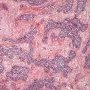 Abdominal desmoplastic small round cell tumor