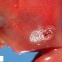 Microtia in trisomy 13