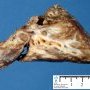 Bronchiectasis and BALT hyperplasia (Case 11750)