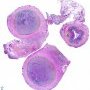 Appendiceal carcinoid tumor