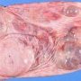 Ovarian cystic juvenile granulosa tumor