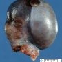 Hemorrhagic necrosis of the testis after torsion