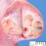 Testicular juvenile-type granulosa tumor